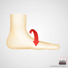 Flat valgus foot pes planovalgus med. Knick Senkfuss Gesellschaft Fur Fuss Und Sprunggelenkchirurgie E V