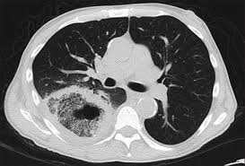 Clinical presentation the presentation can vary, ranging from exophthalmos, rhinorrhea, and ophthalmoplegia. The Reversed Halo Sign And Mucormycosis The Lancet Infectious Diseases