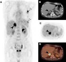 Check spelling or type a new query. Primary Mesothelioma And Extrathoracic Metastasis On 18 F Fdg Pet Ct Download Scientific Diagram