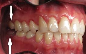 Last Molar Extracted Do I Need A Dental Implant Ramsey Amin Dds