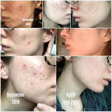 Adapalene is used to treat acne, but does it work? My Journey Thus Far With Active Acne And Hyperpigmentation Deep Scars Main Products Used Banish Products Microneedling Stamp Pumpkin Enzyme Mask Vitamin C Serious Spironolactone Tactu Pump Adapalene Benzoyl Peroxide Acnescars