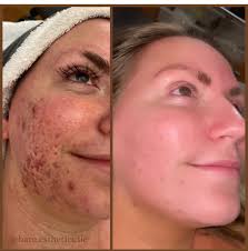Acne Treatments and Anti-Aging Services in Springfield