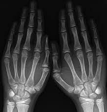 Advanced Bone Age 13 Years In A Patient With Chronological Age Of Download Scientific Diagram