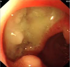 Image result for Colchicine Toxicity