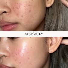 Skin Whitening Supplements in SG