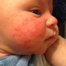 But scratching and rubbing can further. Help Rash Baby Acne August 2015 Babies Forums What To Expect