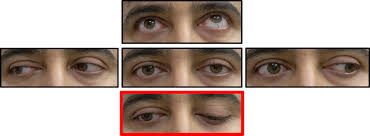 Image result for Pupillary Paralysis