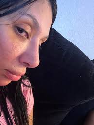 Two weeks post op and I'm very worried I might have saddle bridge . ? My  surgeon had to break my nose because I had deviation and so it's still  swollen. My