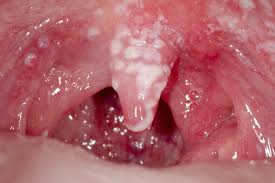 Image result for Oral thrush roof of mouth