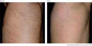The heat from the melanin destroys the follicle and prevents hair from regrowing. Lumenis Laser Hair Removal In Wandsworth Earlsfield Putney Clapham Battersea