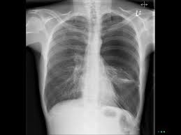 The air then fills the space outside of the lung, between the lung and chest wall. Pneumothorax X Ray Radiological Diagnosis Of Pneumothorax Learn From Doctor