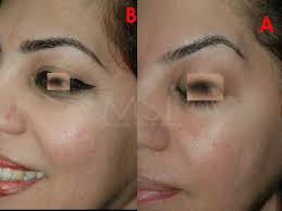 Easy lift instantly lifts droopy eyelids, hooded eyes, and sagging eyelid skin to a more youthful shape. Botox Eye Brow Lift Eyebrow Lift Botox Eyes Brow Lift Surgery