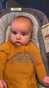 Esclerosis Tuberosa Bebes