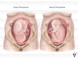 Image result for Breech Delivery