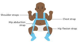 The Pavlik harness - Resource Library - Sheffield Childrens NHS Foundation  Trust