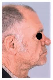 Preoperative presentation. Obvious deformity of the nasal tip and...