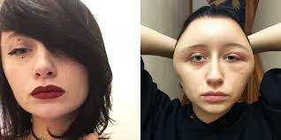 When you suffer from a hair dye allergic reaction, you are bound to experience some symptoms directly on the affected area (contact dermatitis allergic this section is going to focus on treatments as well as ways to ensure you never suffer from such allergies. Woman Had Severely Swollen Head After Allergic Reaction To Hair Dye