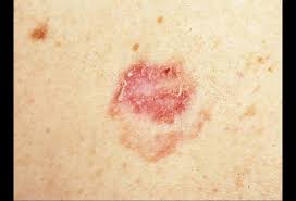 स्कैवम सेल कार्सिनोमा (squamous … Nonmelanoma Skin Cancers You Need To Know