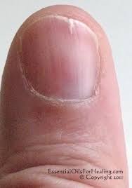 Photo Of Woman S Slightly Split Left Thumb Nail Split Nails Essential Oils Patchouli Essential Oil