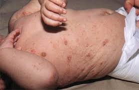 Se estima que la sarna infecta a más de 300 millones de humanos en todo el mundo cada año, incluido 1 millón de personas en los estados unidos. Avances En El Tratamiento De La Escabiosis Escuela De Medicina Facultad De Medicina