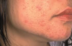 We are regularly pushing the envelope, here on the island, to advance the interests of our clients, whether they are buying or selling. Patients Taking Isotretinoin For Acne May Not Need Monthly Blood Tests The Pharmaceutical Journal