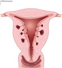 Echographie gynécologique (adenomyose) l'hystéroscopie peut être diagnostique ou opératoire.l'hysteroscopie diagnostique peut se faire sans anesthésie au cabinet a l'aide d'un. L Adenomyose Causes Symptomes Et Traitement Mon Gyneco Et Moi