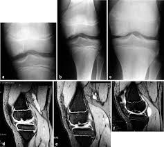 Image result for Ballottable Patella Sign