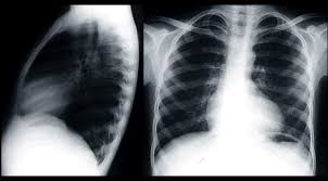 Hypercyanotic Episodes In The Newborn Litfl Paediatric Cases