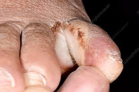 Image result for diabetic toes