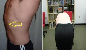 People who have the condition have ribs that stick outward instead of tapering inwards at the bottom of the rib cage. Rib Flare Left Side