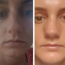 Straightening the Bone