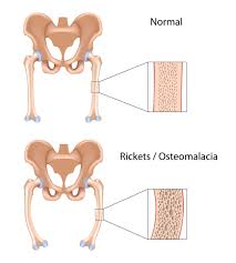 The influence or control over ecological communities exerted by a dominant (see dominant. Hereditary Hypophosphatemic Rickets Medlineplus Genetics