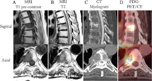 Anatomic And Functional Imaging In The Diagnosis Of Spine Metastases And Response Assessment After Spine Radiosurgery In Neurosurgical Focus Volume 42 Issue 1 2017