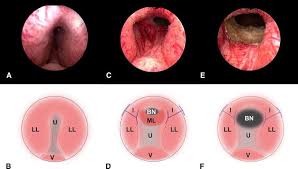 Curp is a unique identification number provided by the mexican government to all residents and citizens. Curp Procedure A B Preop Urethra U Obstructed By The Lateral Download Scientific Diagram