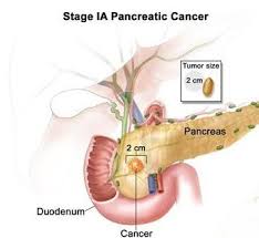 What are the risk factors for developing pancreatic cancer? Pancreatic Cancer Symptoms Signs And Treatment Science Online