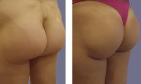 Obtenez un devis gratuit pour avoir le prix. Augmentation Fesses Tunisie Implant Fessier Et Prothese Prix Pas Chers
