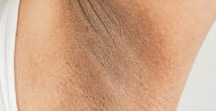 Koltuk Alti Kararmasi Nasil Gecer Koltuk Alti Kararmasi Neden Olur