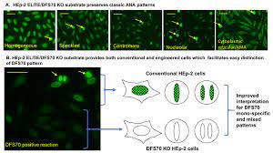Simultaneous Distinction Of Monospecific And Mixed Dfs70 Patterns During Ana Screening With A Novel Hep 2 Elite Dfs70 Knockout Substrate Protocol Translated To German