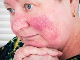 Sie möchten lästige pickel schnell loswerden? Rosazea Hautentzundung Im Gesicht Behandeln Ndr De Ratgeber Gesundheit