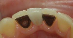 The average bridge lasts between five and seven years, but with proper care, some bridges can last more than a decade. Maryland Bridges Dental Bridges Made At Pearl Dental Clinic
