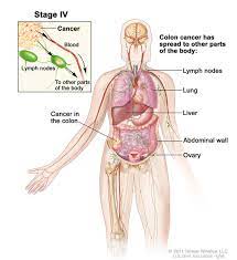 If the rectal cancer has spread into nearby organs, more surgery is needed. How We Diagnose Colon Cancer Dana Farber Cancer Institute Boston Ma