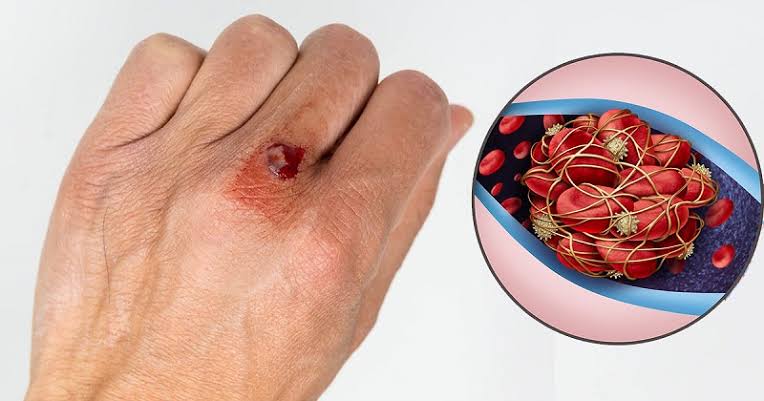 Cục máu đông thường gặp và những điều bạn cần biết - Bệnh Viện Đa Khoa Bắc  Thăng Long