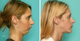 He was a faculty of chulalongkorn medical university, former chairman of society of plastic and reconstructive surgeons thailand, former society of aesthetic plastic surgeons thailand, and former chairman plastic surgery unit … Before After Photos Los Angeles Ca Jaw Surgery La