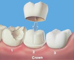 4418 crown squire rd is likely to appreciate by 2% in the next year, based on the latest home price are you hunting for property records for the home located at 4418 crown squire rd, richmond, va. Dental Crowns Grand Parkway Smiles Tooth Crowns Richmond 77407