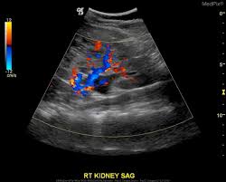 Medpix Case Autosomal Recessive Polycystic Kidney Disease