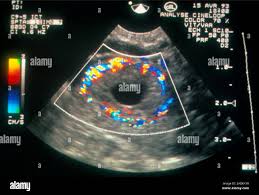 Image result for corpus luteum sonography)