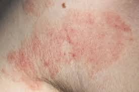 Image result for Contact Dermatitis