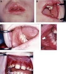 A Prospective Study Of The Oral Manifestations Of Crohn S Disease Clinical Gastroenterology And Hepatology