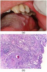 Image result for spinocellular carcinoma of the oral cavity