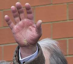 I started competing as a 242 (weighed 235) then decided to drop some weight, and. Prince Charles Reveals Cracked And Tired Looking Hand Daily Mail Online